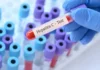 Mitos e verdades sobre as silenciosas hepatites virais